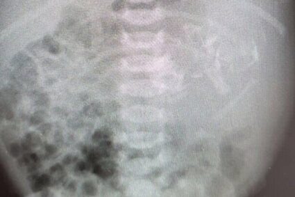Fetus in fetu